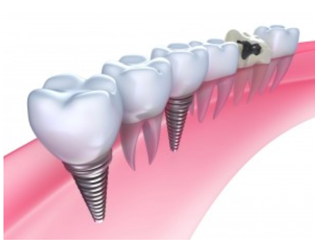All On Four Dental Implants Long Island